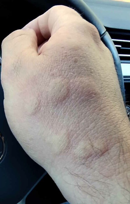 Großaufnahme meiner Hand, auf der sieben Mückenstiche zu sehen sind.